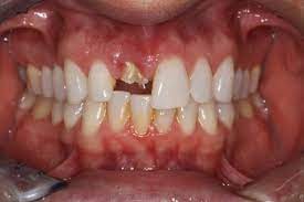 Broken Tooth Becomes A Smile Makeover Cary Family Dental Dr Allan Acton