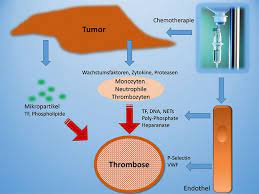 Krebserkrankungen Und Thrombose Trillium Gmbh Medizinischer Fachverlag
