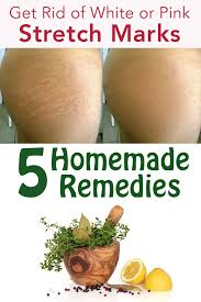 How Can You Get Rid Of White Or Pink Stretch Marks Stretch Mark Remedies Stretch Marks White Stretch Marks