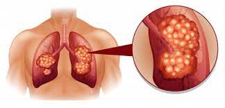 The main symptoms of mesothelioma of the lungs are shortness of breath and chest pain. Mesothelioma Treatment Top Treatment Options