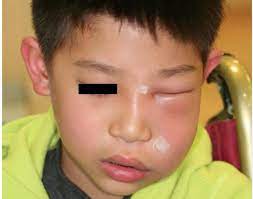 5歲男童半邊臉腫成「麵龜」 竟是「一顆蛀牙」害慘他！ | ETtoday健康雲| ETtoday新聞雲