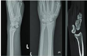Image result for Lunate Dislocation