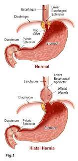 Common symptoms of a hiatal hernia. Hiatal Hernia Acid Reflux And Gerd