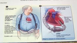 Cardiac rehabilitation is a customized program of exercise and education, designed to help you improve your health and recover from a heart attack, other forms of heart disease or surgery to treat heart disease. Umc Adds Lvad To It S List Of Procedures
