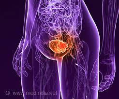 Your doctor or lab tech will only detect it with a urine. Bladder Cancer Symptoms Signs Diagnosis Treatment Prognosis Prevention