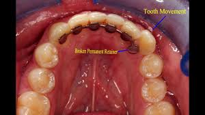 7.4 how long does invisalign take to straighten teeth? Teeth Shifting After Orthodontic Treatment Youtube