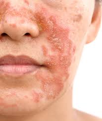 Image result for Seborrheic Dermatitis