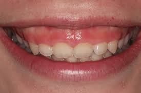 How To Fix A Gummy Smile Dentist In Madison Wi