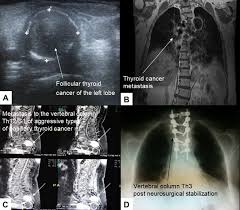 Each treatment causes side effects that can. Does Every Classical Type Of Well Differentiated Thyroid Cancer Have E Cmar