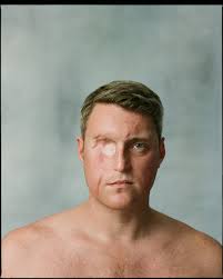 My name is Dan and I had cancer in my face.