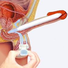 Image result for Penile Prosthesis