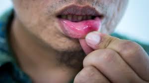 Symptoms of herpes on buttocks. Herpes Simplex Virus Hsv And Hiv