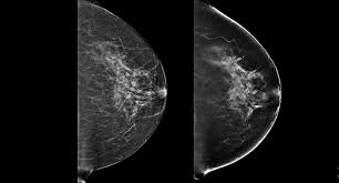 If a doctor suspects an abnormal growth in the breast after a clinical breast examination or screening mammography, evaluation of breast cancer ultrasound images will help confirm the diagnosis. 3d Imaging Technology Could Improve Outcomes For Patients With Breast Cancer Lawson Health Research Institute