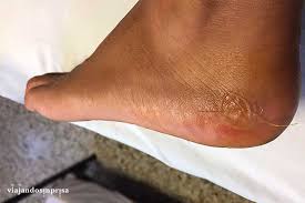 Introduce los pies en un recipiente de agua fresca con sal gruesa, durante, al menos, unos 15 minutos. Como Curar Las Ampollas De Los Pies En Minutos