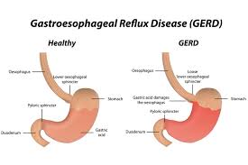 Gerd stands for gastroesophageal reflux disease, which is the backflow of stomach contents (including stomach acid) upward into the esophagus (the swallowing tube that extends from the mouth. Gerd Acid Reflux Causes Symptoms Treatment Parkway East Hospital