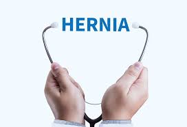 Umbilical Hernia After Delivery Causes Signs Treatment