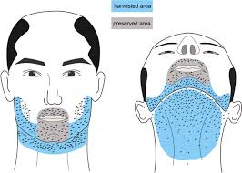 Nevertheless, the eyebrow hair transplant in india costs around ₹ 25,000 to 70,000. Large Scale Beard Extraction Enhances The Cosmetic Results Of Scalp Hair Restoration In Advanced Androgenetic Alopecia In East Asian Men A Retrospective Study Springerlink