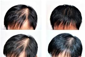 The treatment takes about eight minutes and should be completed at least three times a week for optimal results. Hairfortin Quality Production For Baldness Hair Loss Treatment Laser Hair Regrowth Anti Hair Loss