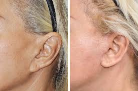 An operation to achieve the pixie ear look is one quite painful and not just a case of cutting and reshaping skin. Earlobe Repair Otoplasty Dr Benjamin Paul