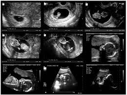 Wrong Due Date From Ultrasound Scan Why It Happens Madeformums