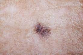 types of skin and nail problems during cancer treatment various cancer treatments can cause skin and nail problems for cancer patients, including: Most Melanomas Grow As New Spots Not From Existing Moles
