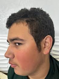 My son has always had red cheeks, which isn't common for someone with olive  skin tone. When he gets sun or sweats, they turn more red. These pictures  are of him naturally,