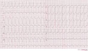 Vtach may turn into vfib patient is pulseless, unconscious, crashing only treatment is electrical cardioversion. Ventricular Tachycardia Electrocardiogram Wikidoc
