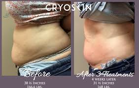 It has been in premium spas throughout europe and we are proud to offer this treatment. Cryoskin Cryotherapy For Slimming In Harker Heights Tx