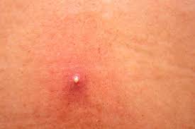 Image result for genital herpes