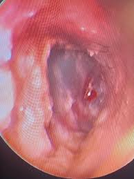 Image result for Acute Otitis Externa