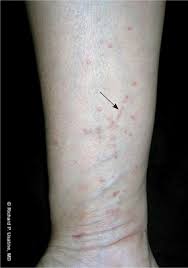 Rings of clustered lesions with central clearing. Diagnosis And Treatment Of Lichen Planus American Family Physician