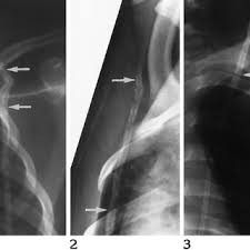 Pdf Subcutaneous Catheter Calcification In Ventriculoperitoneal Shunts