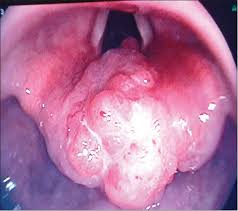 Laryngeal cancer is a disease in which malignant (cancer) cells form in the tissues of the larynx. Primary Small Cell Carcinoma Of The Larynx Sharma Jd Baishya N Rahman T Krishnatreya M Kataki Ac Singh A Clin Cancer Investig J