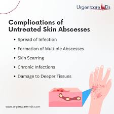Image result for Skin Abscess