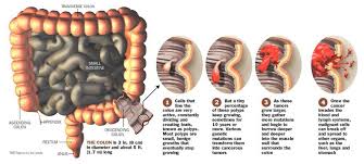 Pin On Colon Cleanse
