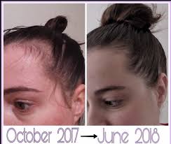 I can still remember those times when i have to unclog the drain in the middle of my shower because my hair is falling. Postpartum Hair Loss Postpartum Hair Loss Monat Hair Hair Loss