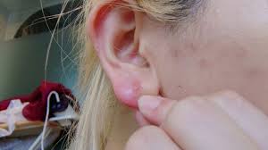 Aural pimples (pimples on the ear) are not only painful when squeezed, but if they are on the fleshy lobe of the ear or inside the ear, they can bleed for some time afterwards and cause more problems.3 x trustworthy source american academy of dermatology professional organization made of over 20. Tips To Get Rid Of Pimple In Earlobe