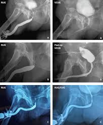 Image result for Urethral Stricture
