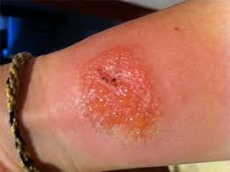 Image result for dermatitis contacta allergica