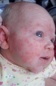 Dermatita atopica este foarte usor de recunoscut: Pete Rosii Care Apar Si Dispar La Bebelusi Qbebe Ro