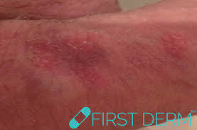 Specializes in obstetrics and gynecology rash: Sex Rash Weird Skin That Shows Your Partner Girlfriend Boyfriend Cheated