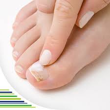 Image result for Akutní zánět nehtového lůžka