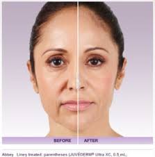 I am 63 and would like to start slowly. How Much Does Juvederm Dermal Filler Cost In Beverly Hills Los Angeles