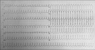 Camels have many adaptations that allow them to live successfully in desert conditions. Neonatal And Pediatric Arrhythmias Cardiac Electrophysiology Clinics
