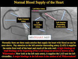 Widowmaker Heart Attack Explained By Cardiologist Myheart