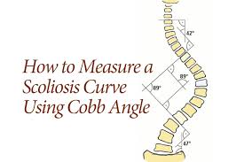 how scoliosis is measured by the cobb angle