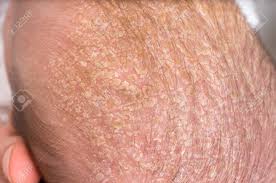 Are you frustrated due to the aggravated find out dandruff treatments and cures for dandruff by going through the answers for these frequently asked. Little Newborn Baby With Psoriasis Or Dandruff In The Hair Stock Photo Picture And Royalty Free Image Image 115661002