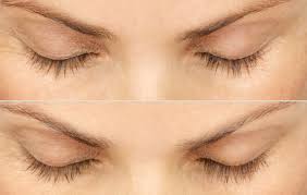 Your age, genetics, and hormones are factors that affect the rate of eyebrow regrowth. 6 Things You Need To Know Before Trying Latisse Women S Health