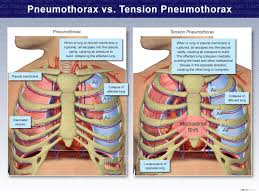 Image result for Open Pneumothorax