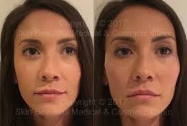 Pdo Thread Lift By Global Expert Helen Bowes Cheek Lift And V Lift Cupid S Bow Enhancement Too Thread Lift Cheek Lift Dermal Fillers